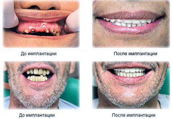 имплантация