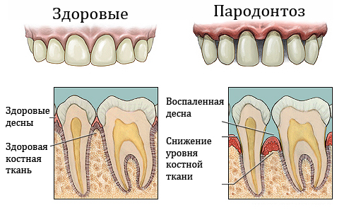 лечение пароднтоза