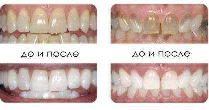 эффективность отбеливания
